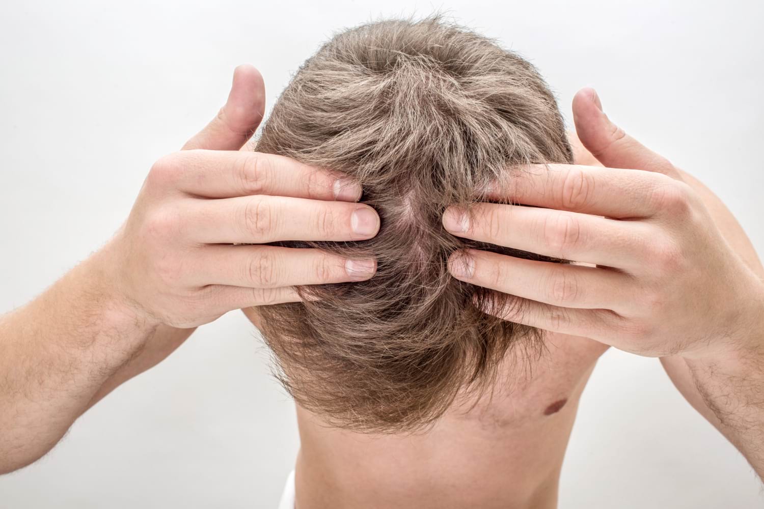 leczenie łysienia Warszawa